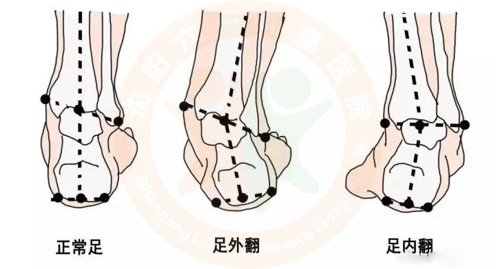 沈阳六一儿童医院特邀专家韩作峰教授专治小孩马蹄足内翻
